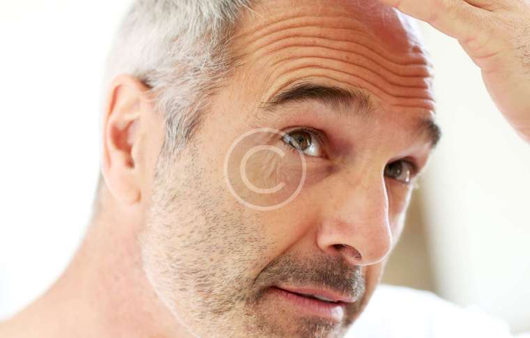 Hair Transplant (FUE & DHI)